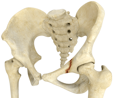 Falls and Hip Fracture